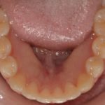 Bottom View of Teeth